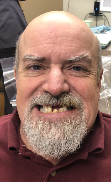 AJ Bogue, volunteer coordinator for the Downtown Washougal Association, shows his teeth prior to receiving dental work in January from Dr. Justin and Tarra Cochell of Washougal Family Dental, who provided the extractions, followed by dentures, at no cost.